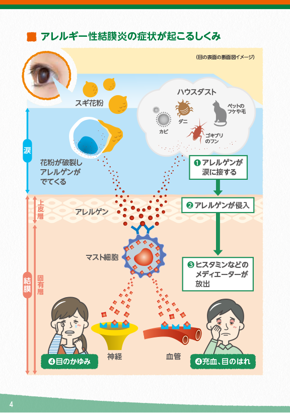 アレルギー性結膜炎の症状が起こるしくみ1