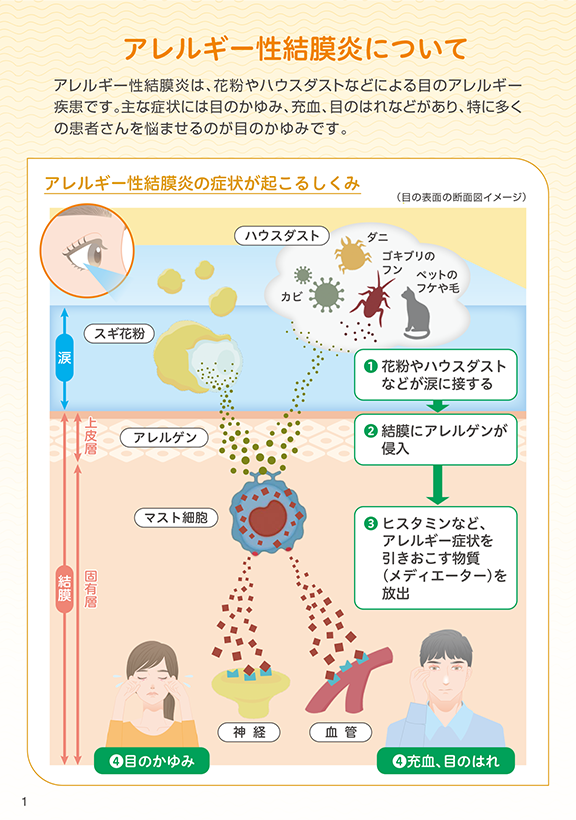 アレルギー性結膜炎について