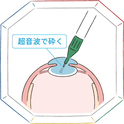 超音波で砕く