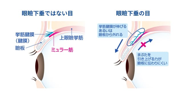 眼瞼下垂のメカニズムの図解。眼瞼下垂ではない目（左）と、挙筋腱膜の緩みによりまぶたが下がった眼瞼下垂の目（右）の断面比較。