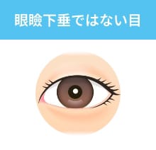 眼瞼下垂ではない目
