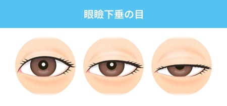 眼瞼下垂の目