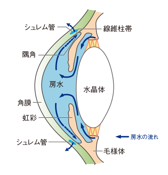 原発開放隅角緑内障（広義）