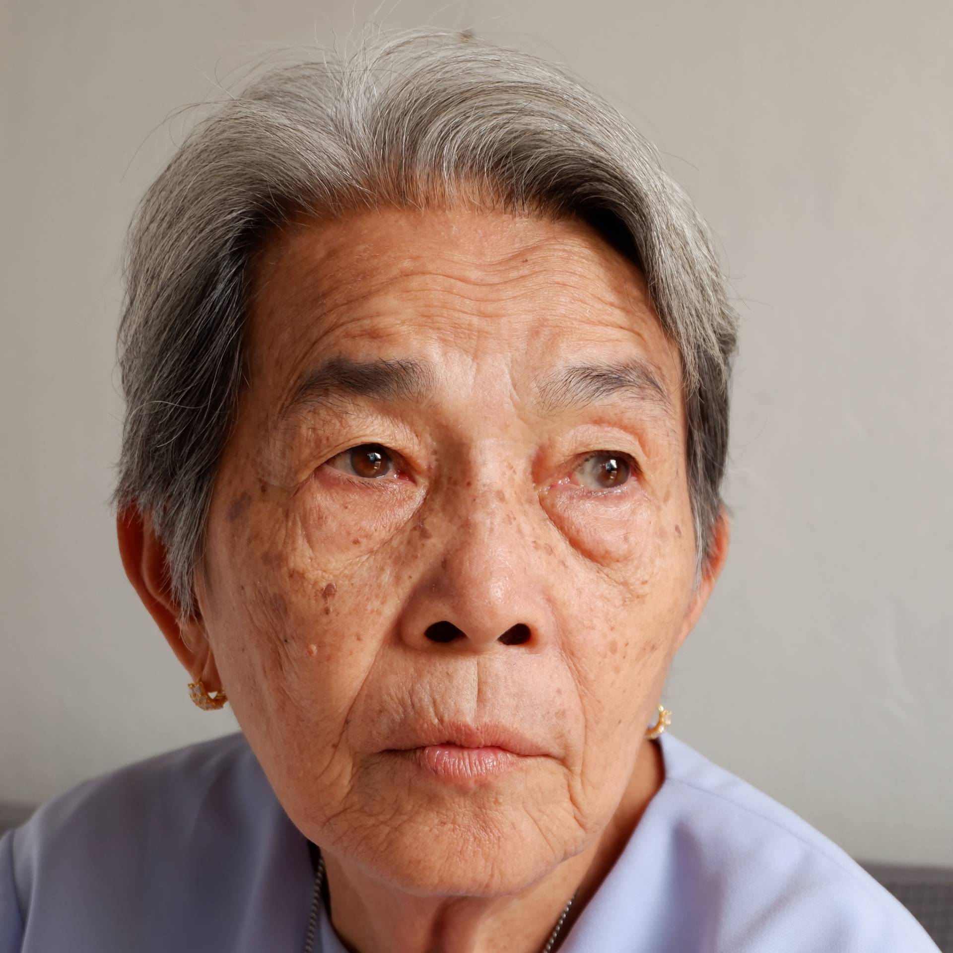Cataract Surgery Aftercare cataract-surgery-aftercare