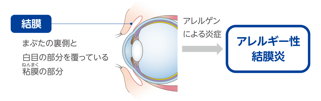 結膜とアレルゲンによる炎症の関係を示すイラスト