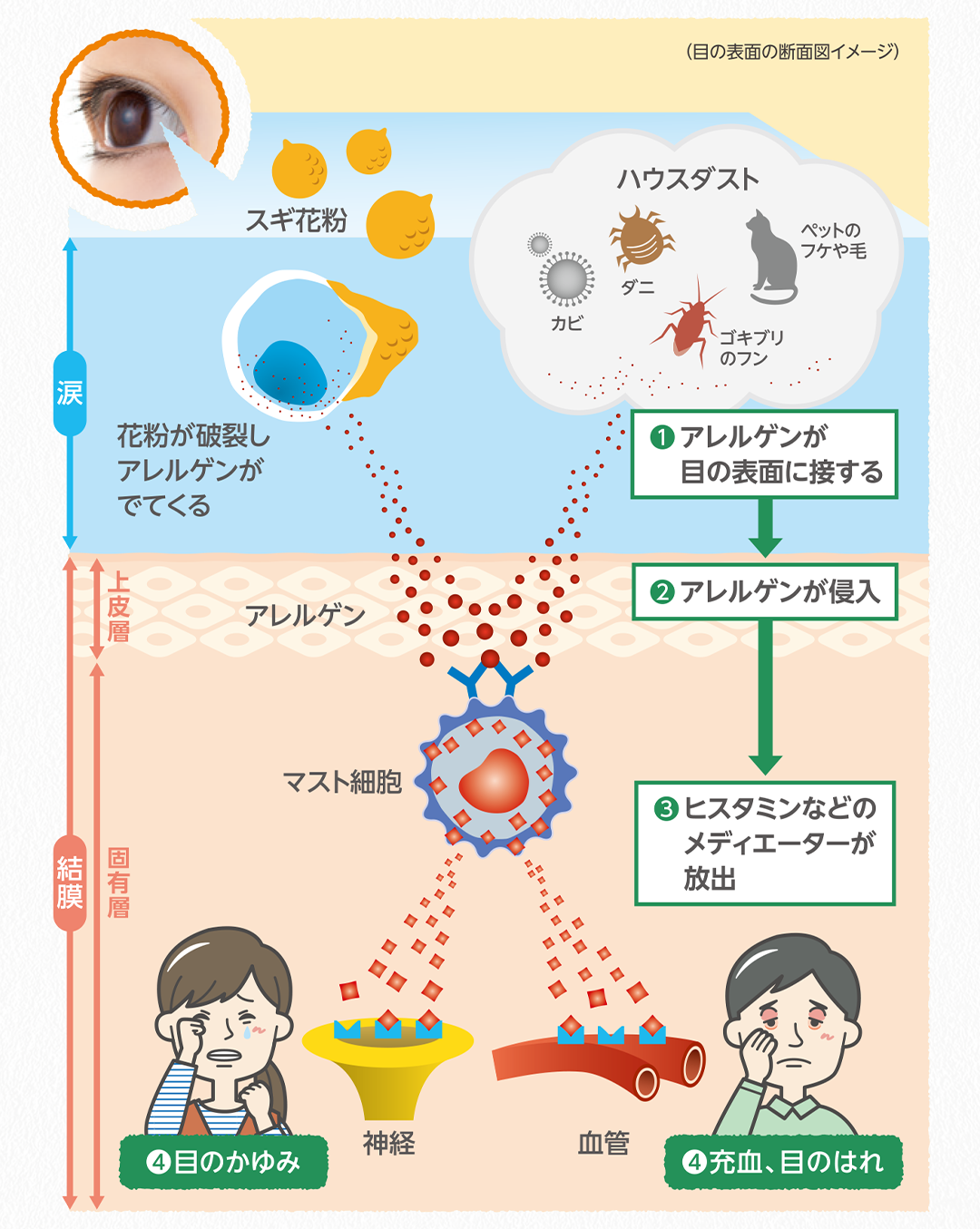 アレルギー性結膜炎の症状がおこる仕組みのイラスト