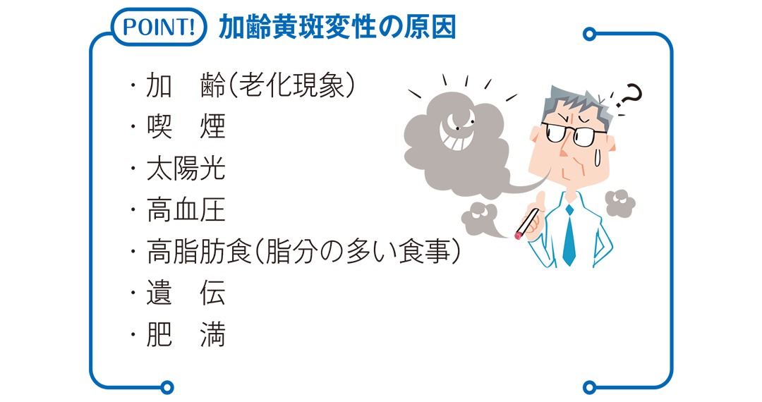 加齢黄斑変性の原因を説明したイラスト