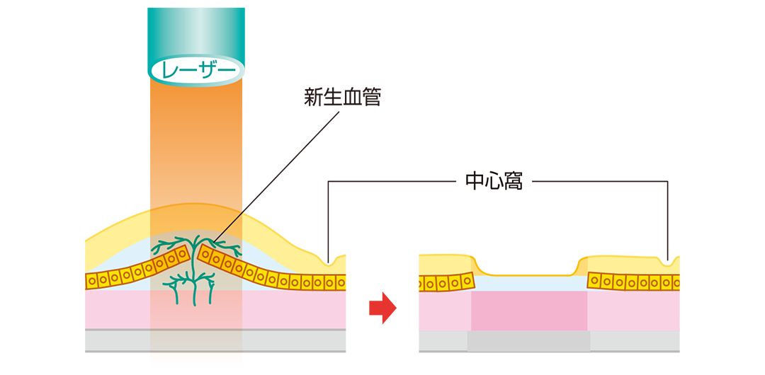 レーザー光凝固術を説明したイラスト
