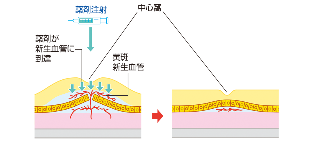 抗VEGF療法を説明したイラスト