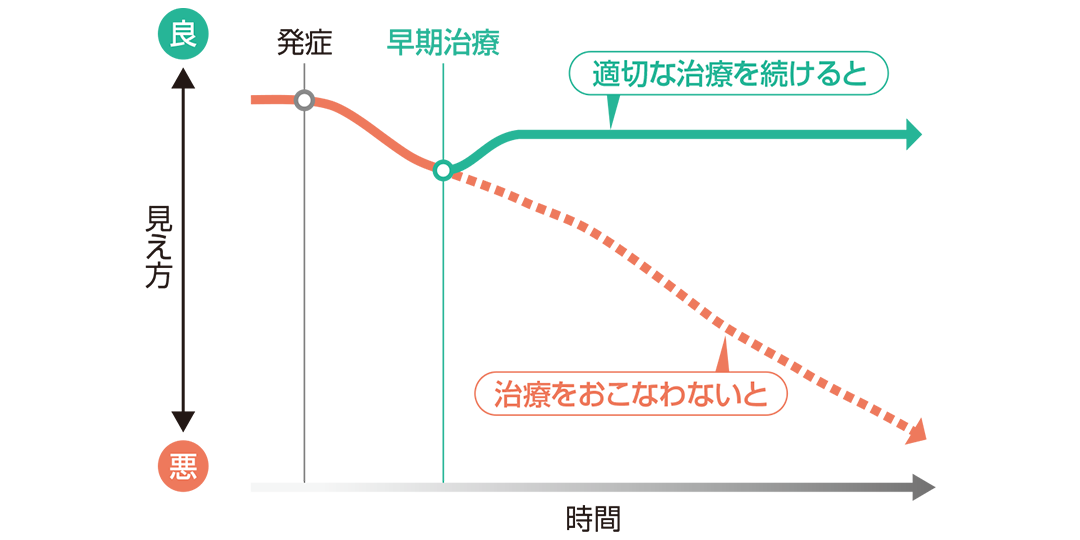 加齢黄斑変性の見え方の変化を説明したイラスト