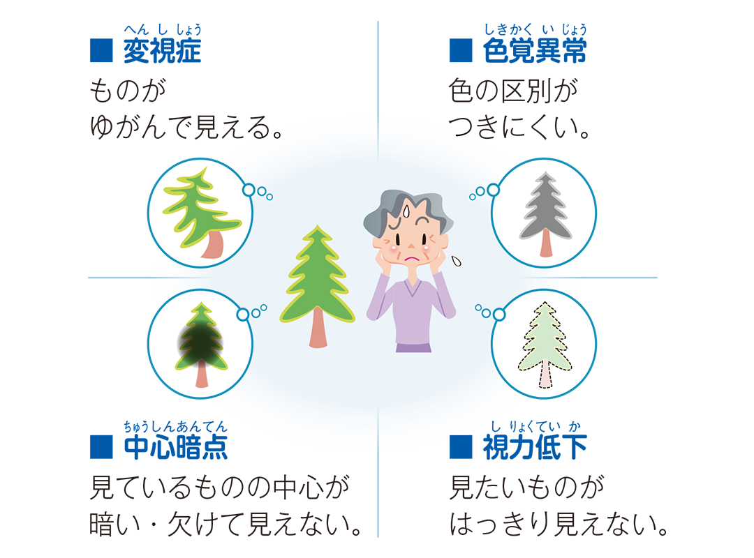 加齢黄斑変性の主な症状を説明したイラスト