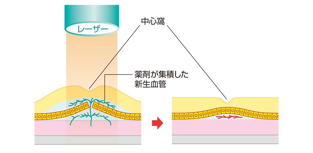 光線力学療法を説明したイラスト