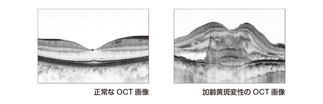 正常なOCT画像と加齢黄斑変性のOCT画像