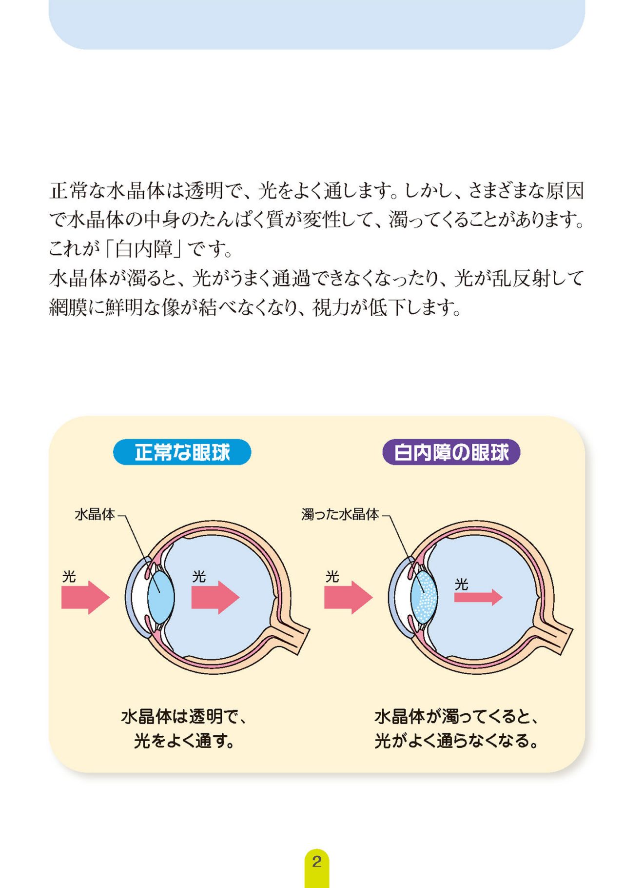 白内障の原因と症状
