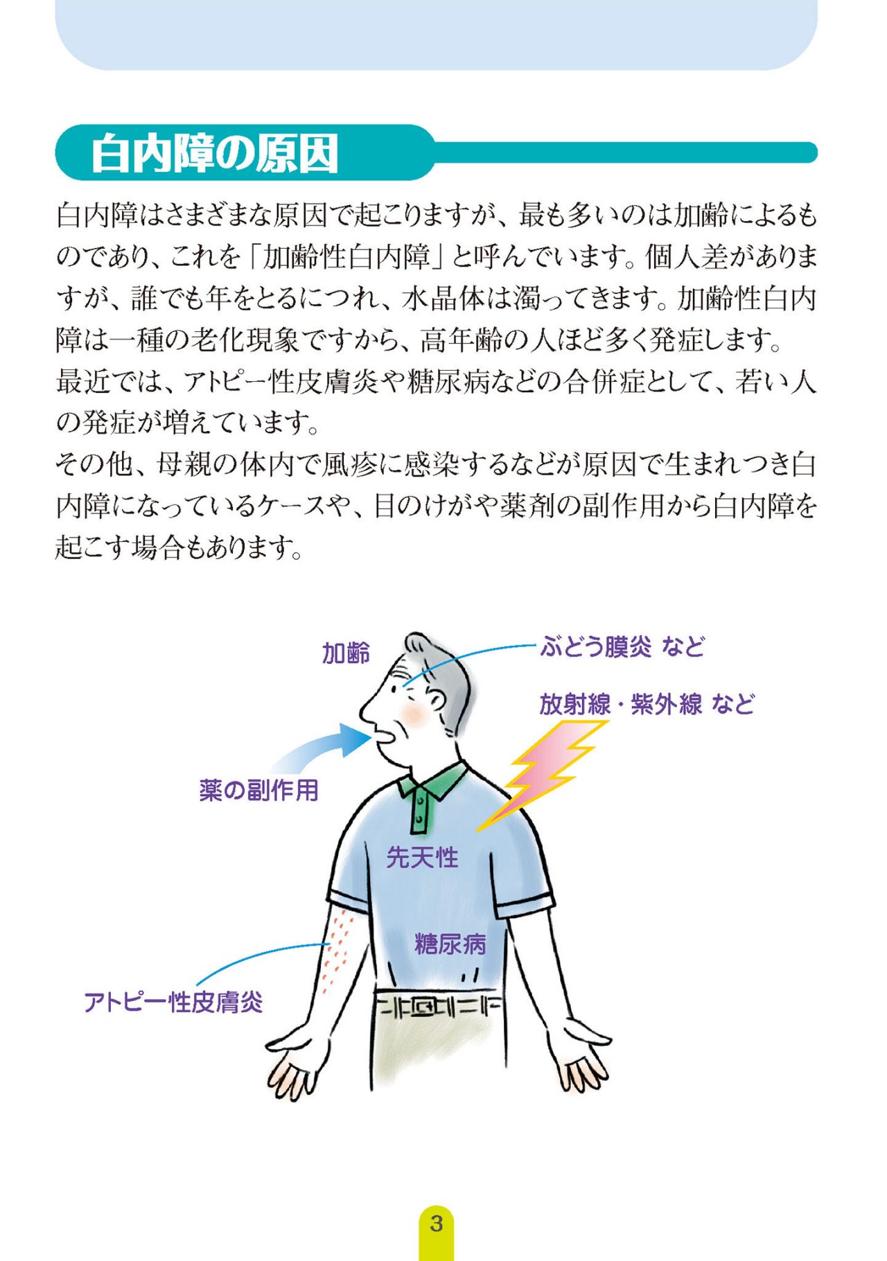 白内障の原因