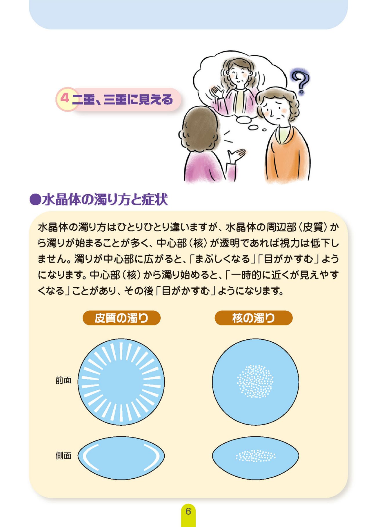 白内障の症状