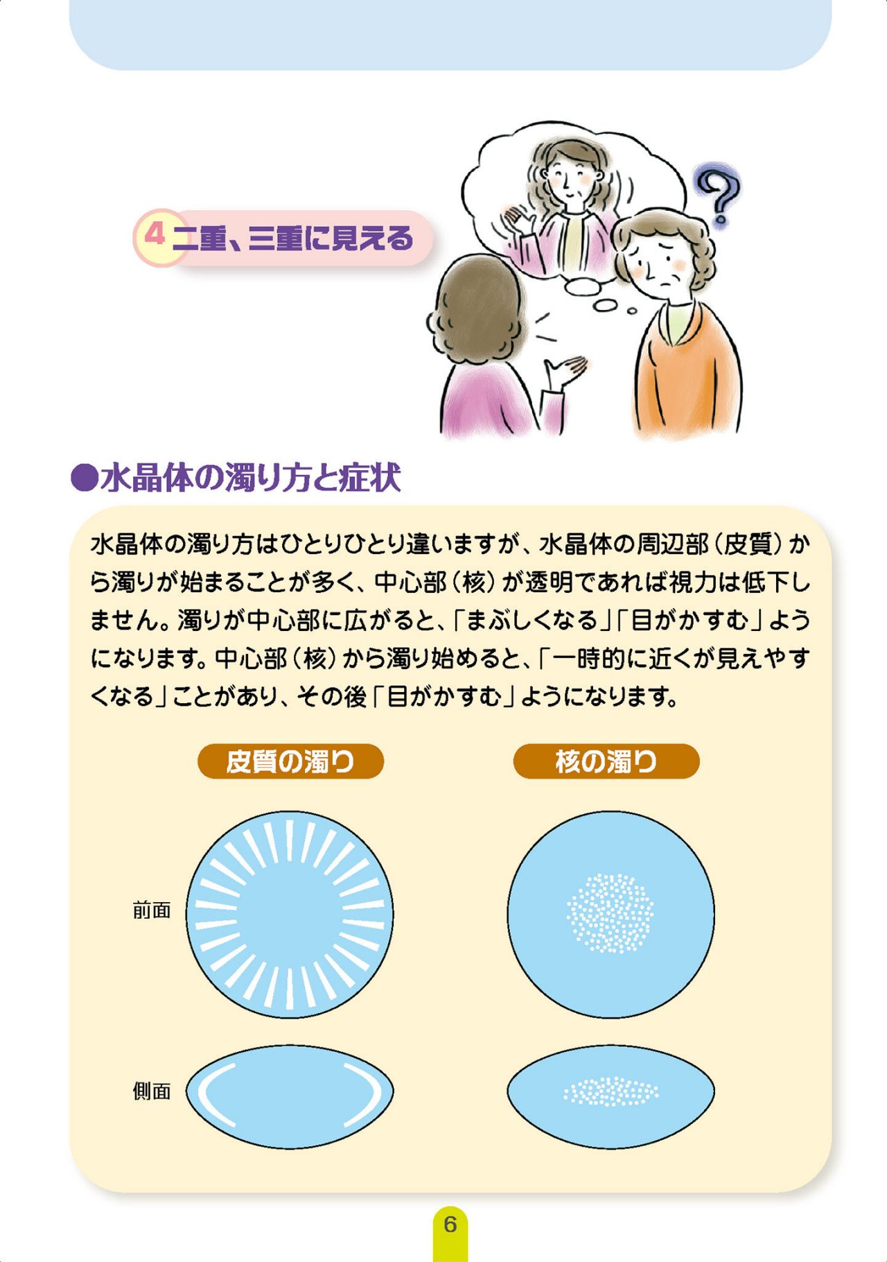 白内障の症状