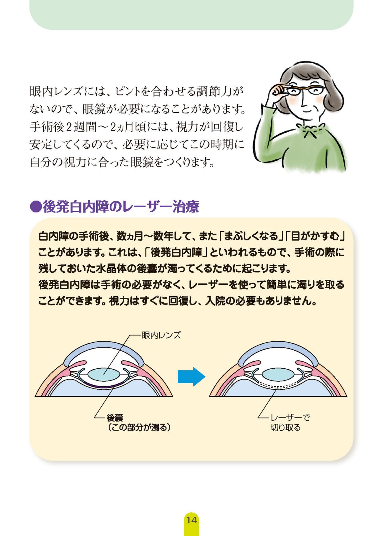 白内障手術後の経過と養生