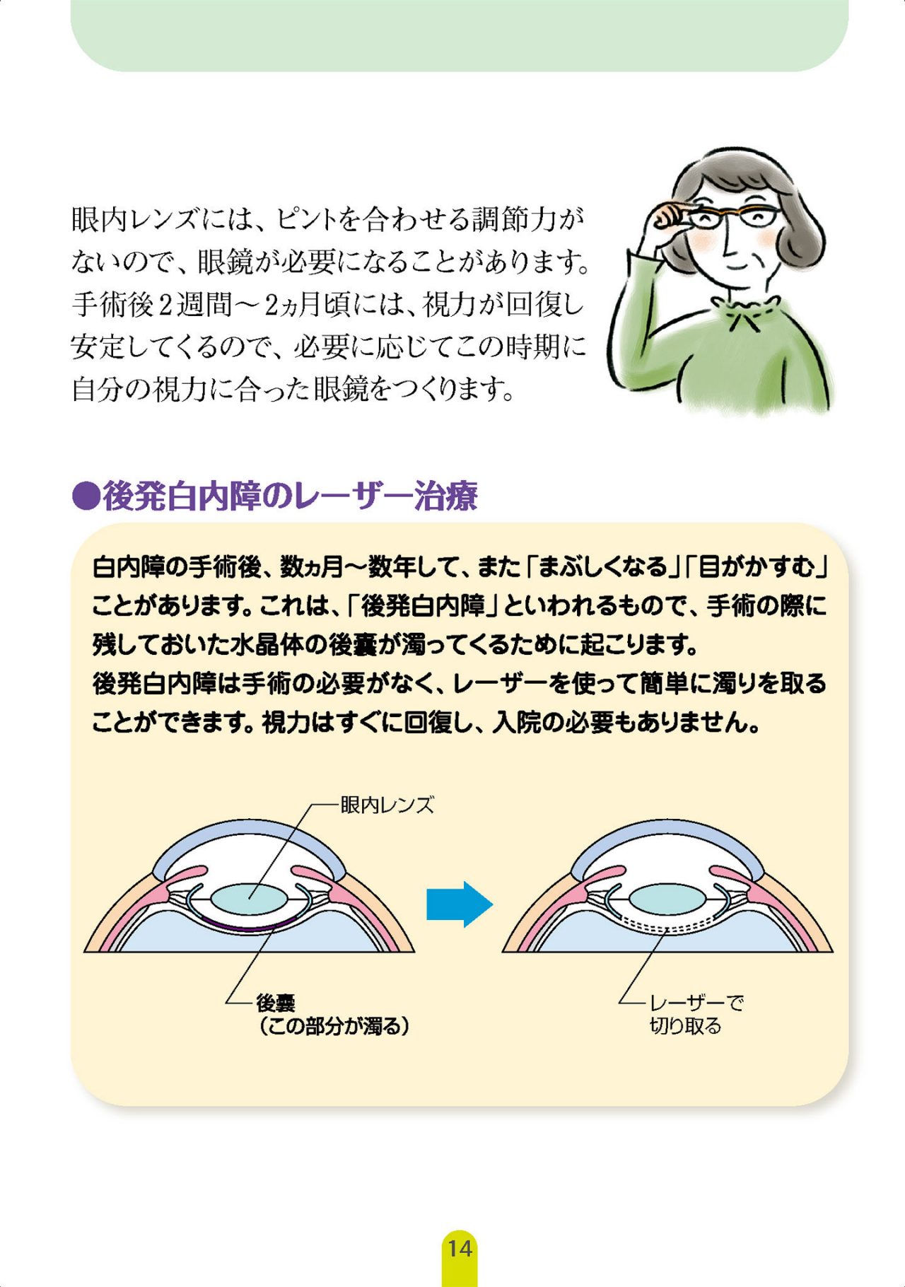 白内障手術後の経過と養生