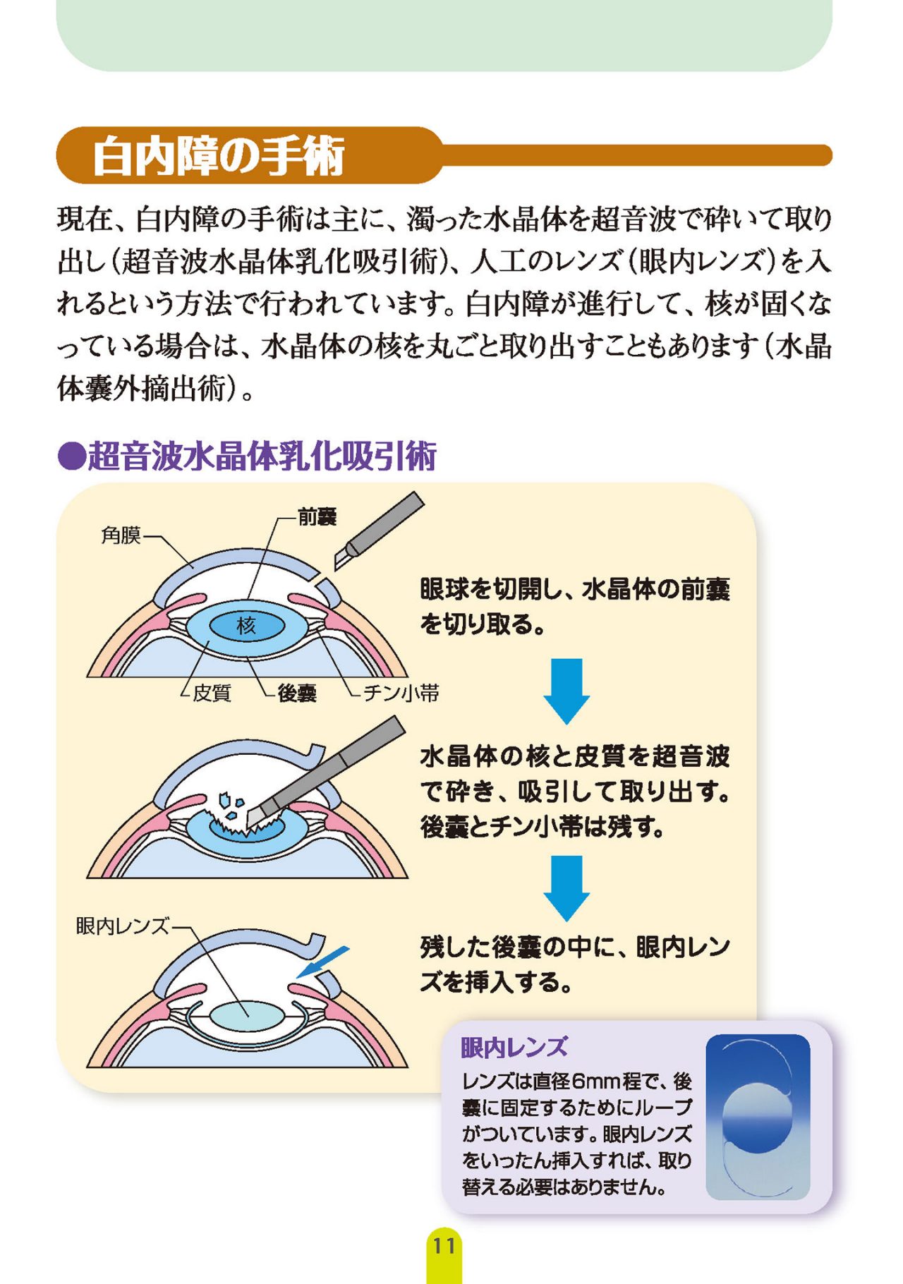 白内障の手術
