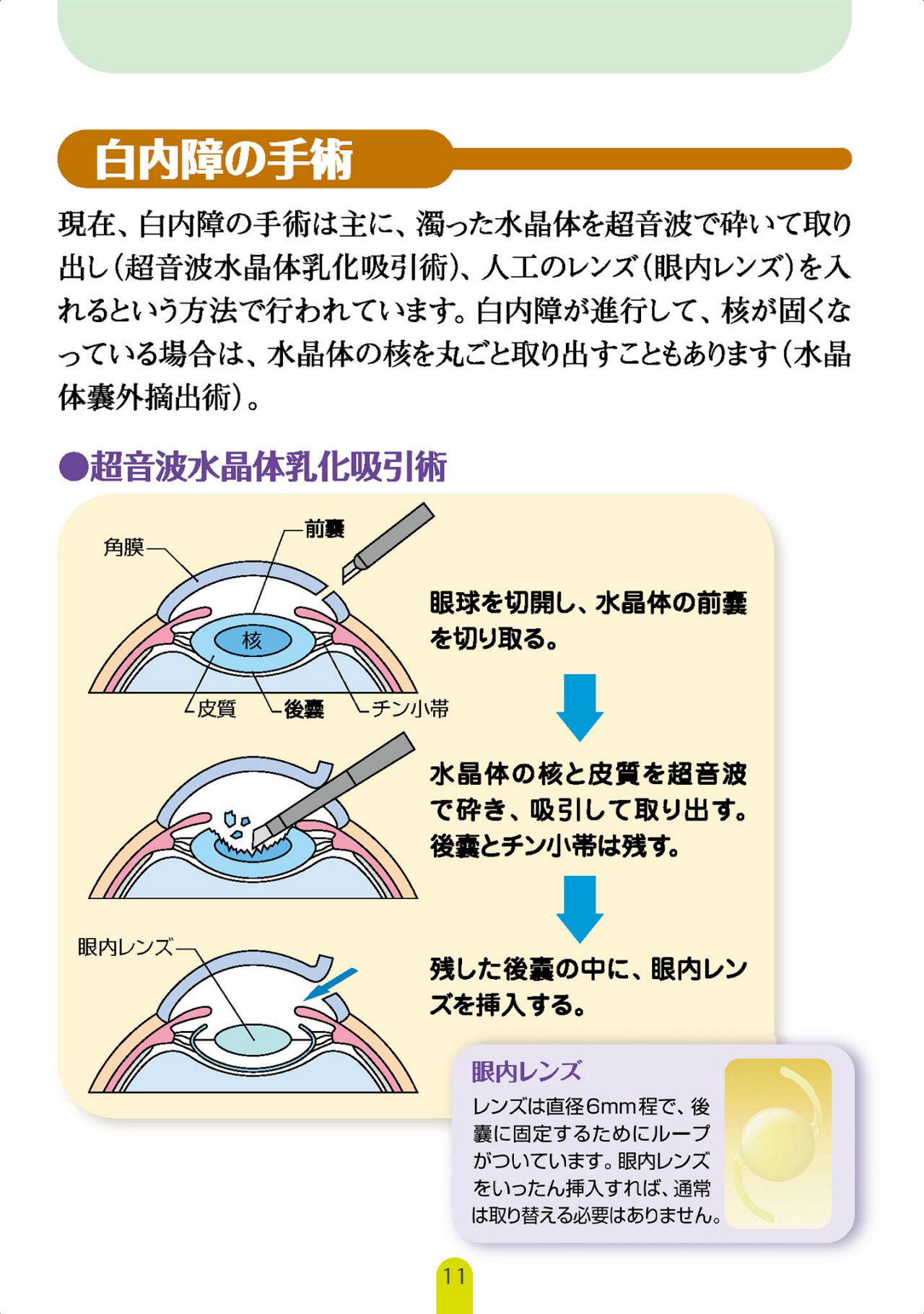 白内障の手術