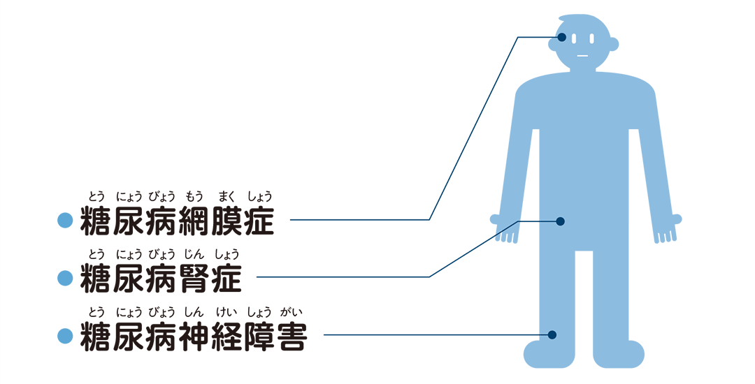 糖尿病の主な合併症を説明したイラスト