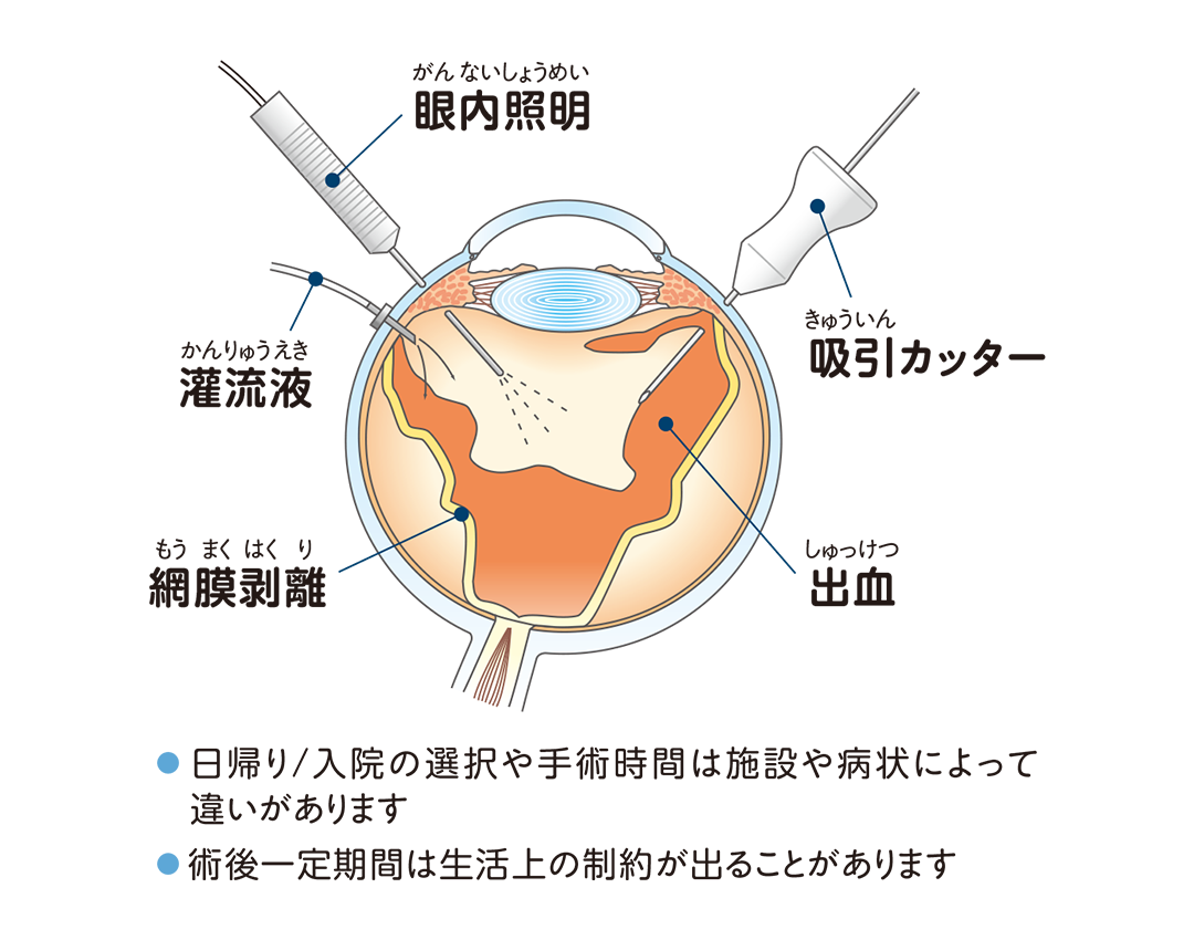 硝子体手術を説明したイラスト