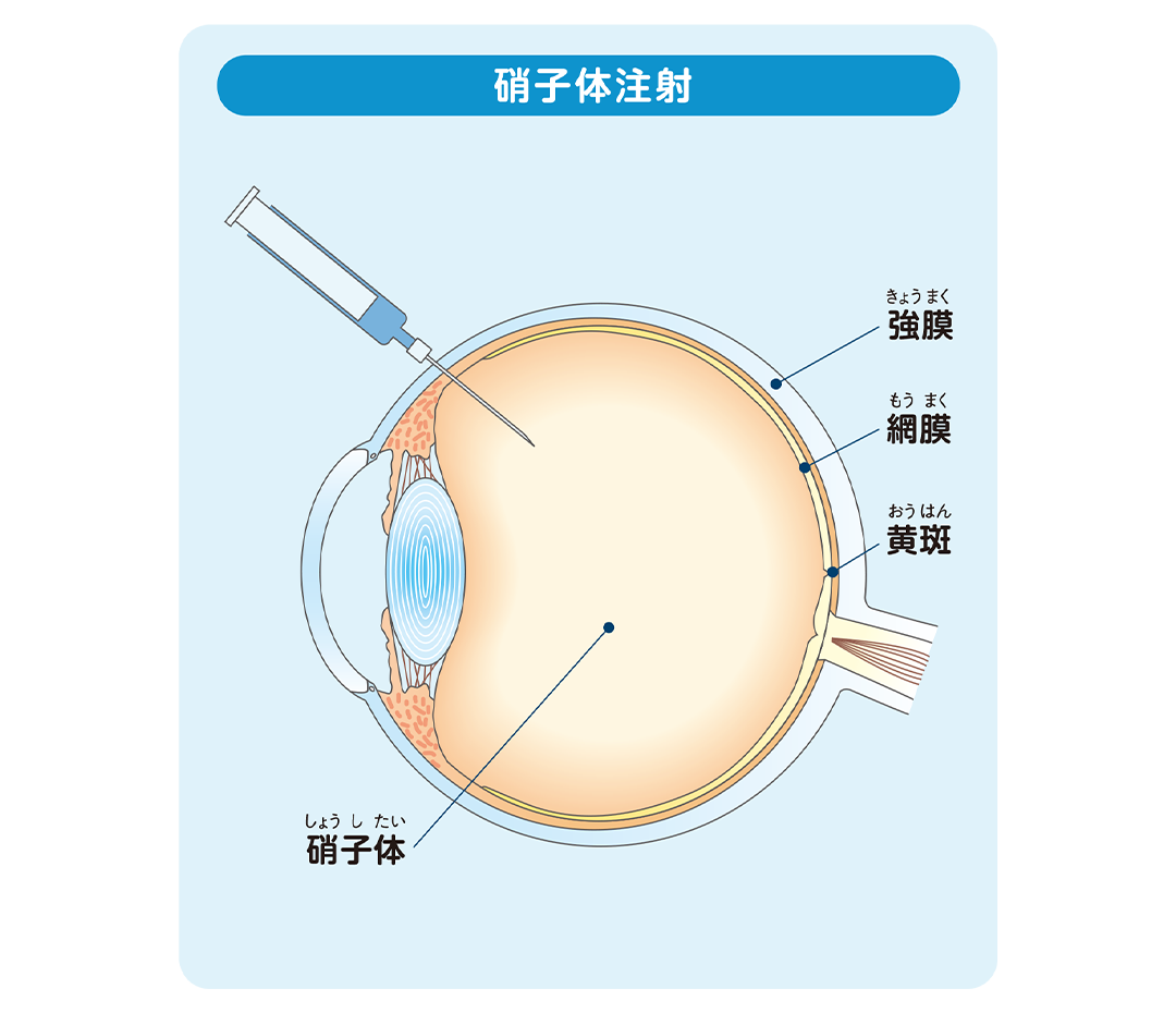硝子体注射を眼球断面図を用いて説明したイラスト