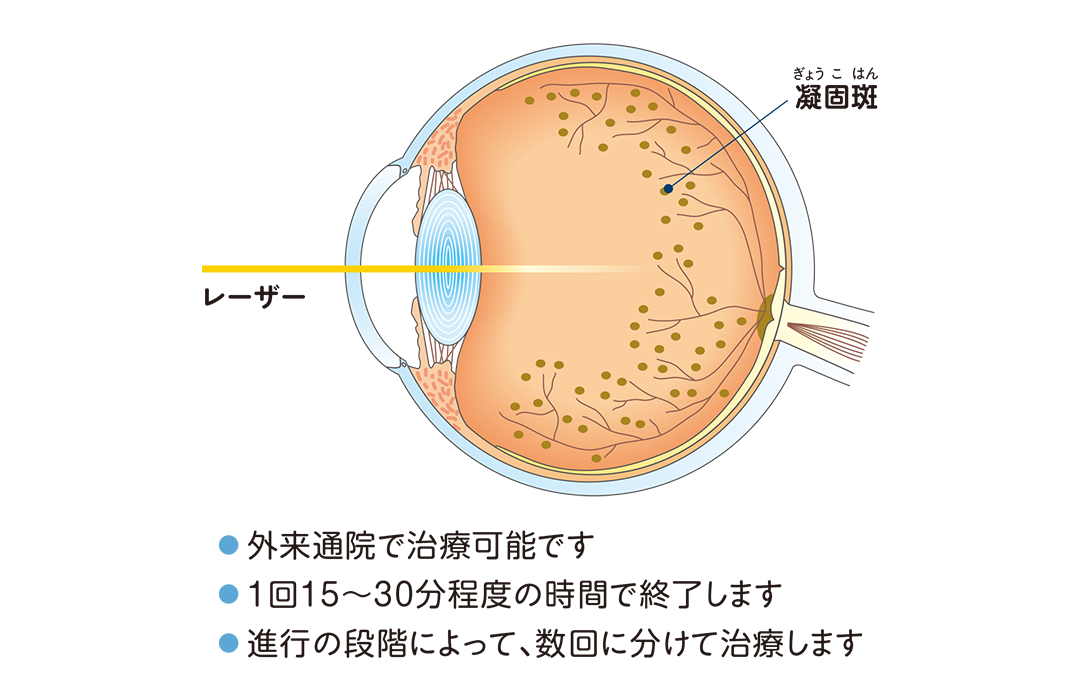 レーザー光凝固術を説明したイラスト