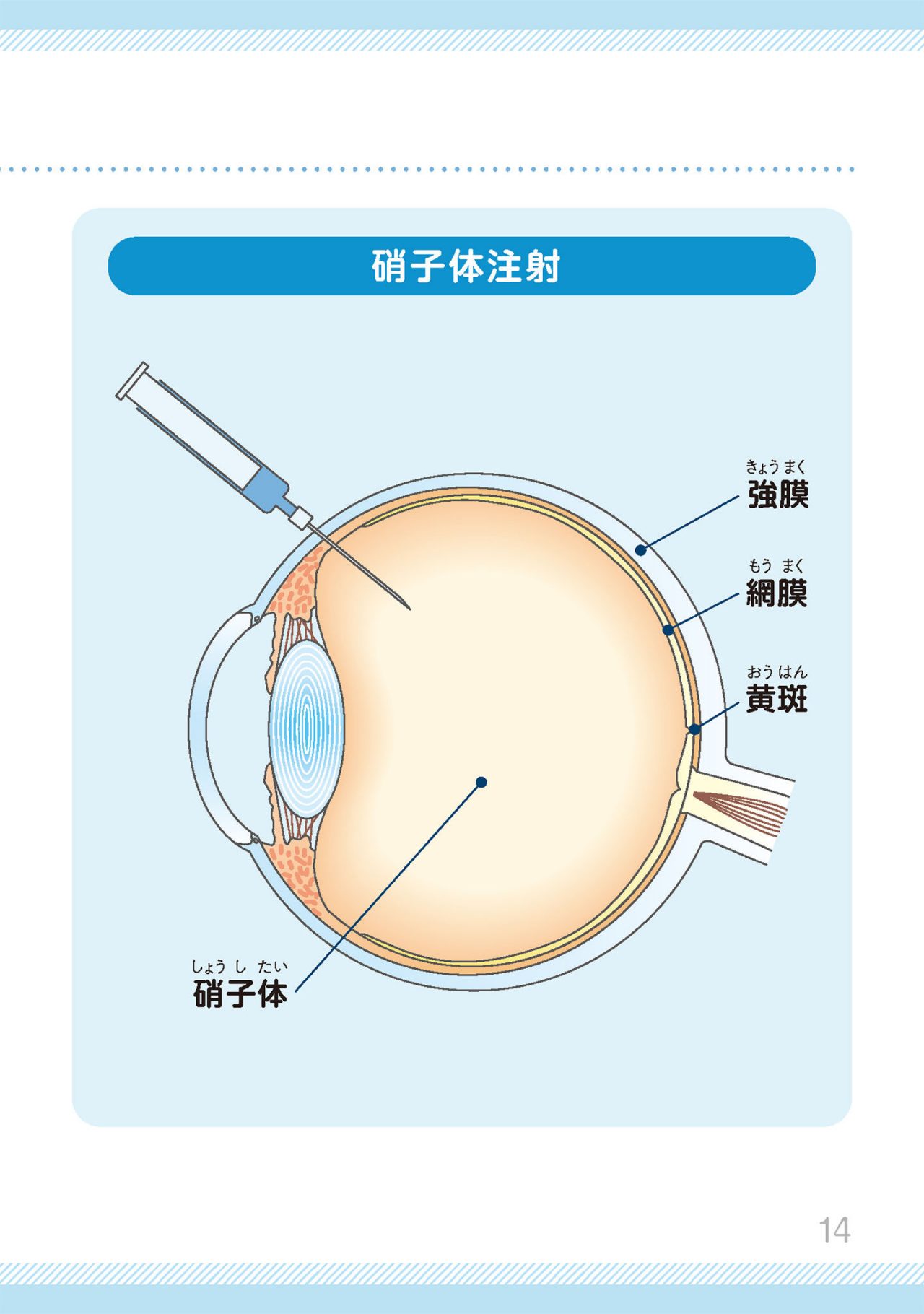 糖尿病網膜症の治療には、どのようなものがあるますか？