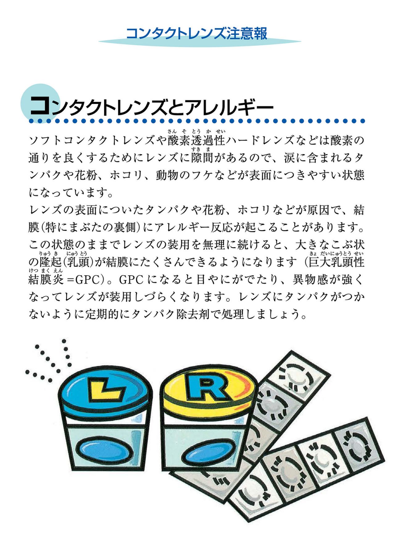コンタクトレンズとアレルギー