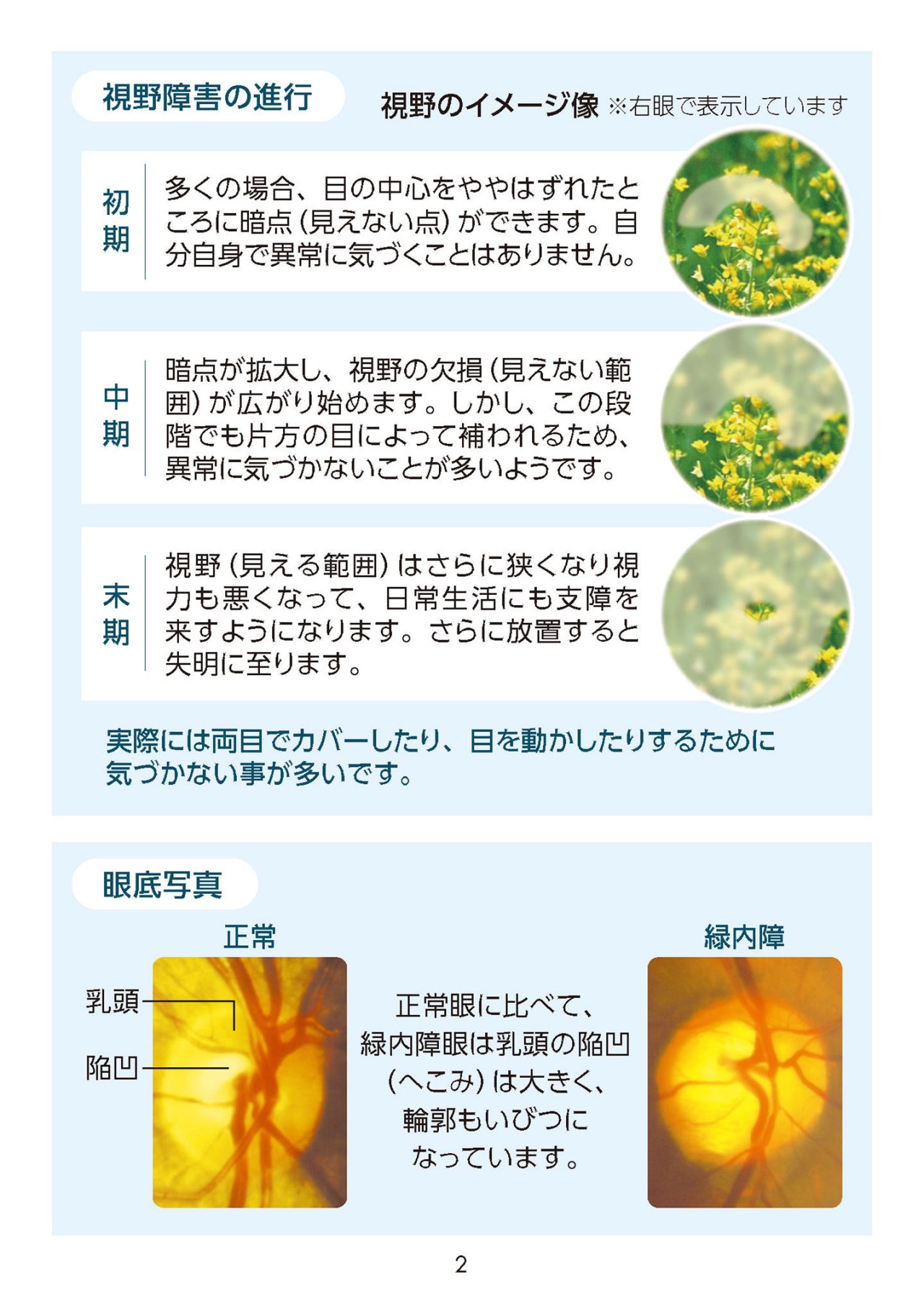 視野障害の進行