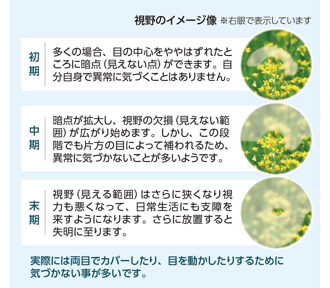 視野障害の進行の状態の説明と視野のイメージ像のイラスト