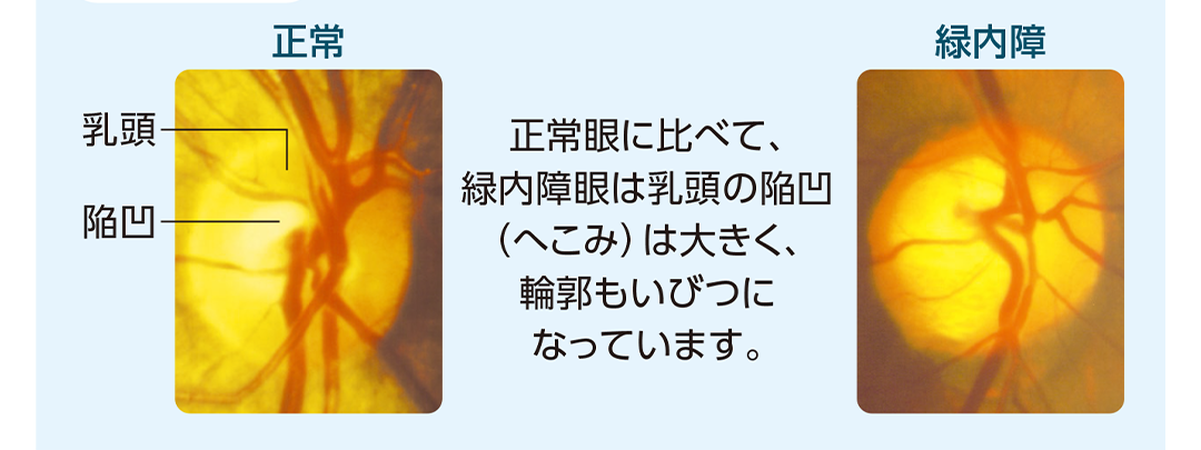 正常な眼底写真と緑内障の眼底写真