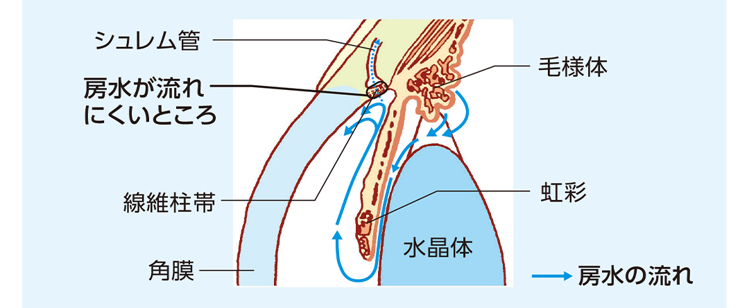 原発開放隅角緑内障の房水の流れを示したイラスト