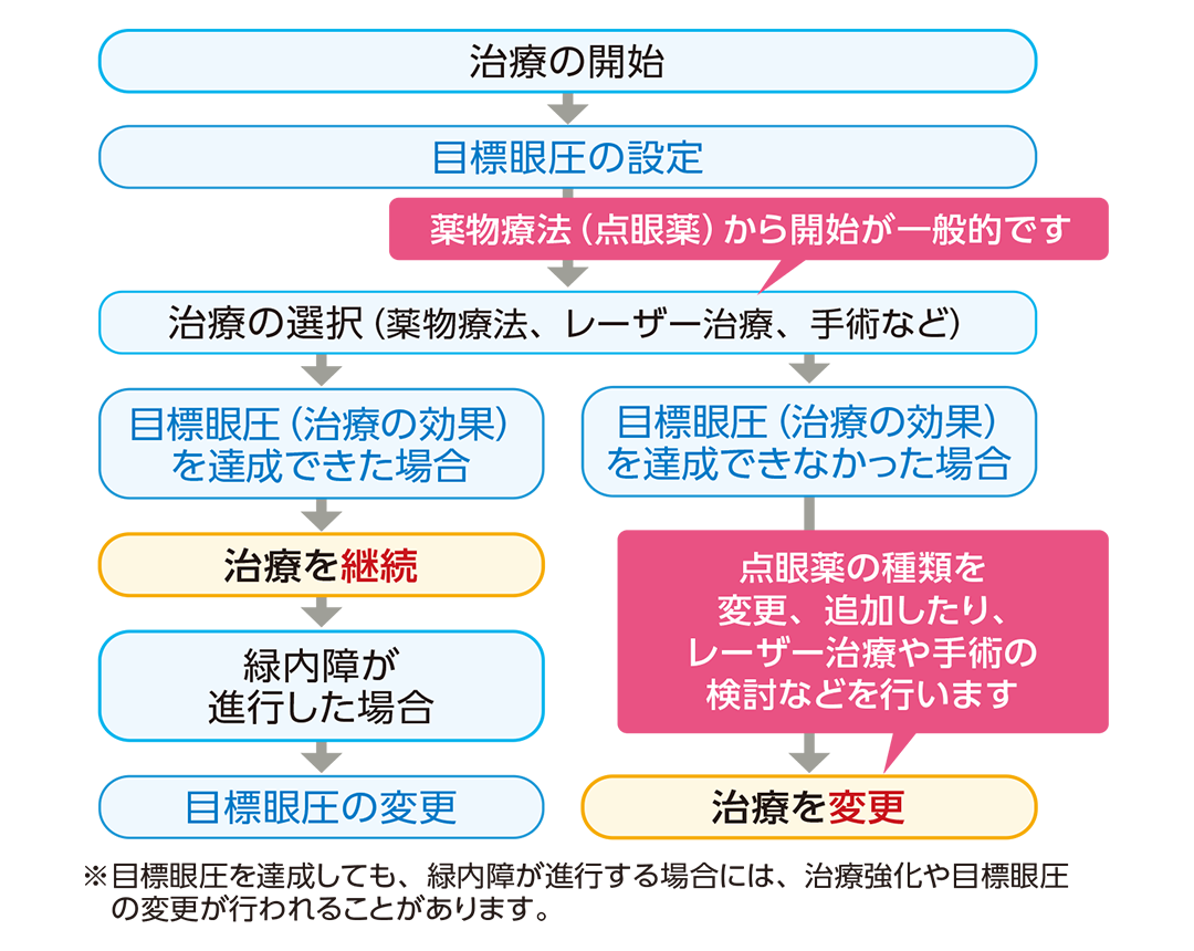 緑内障の一般的な治療法の流れを示したイラスト
