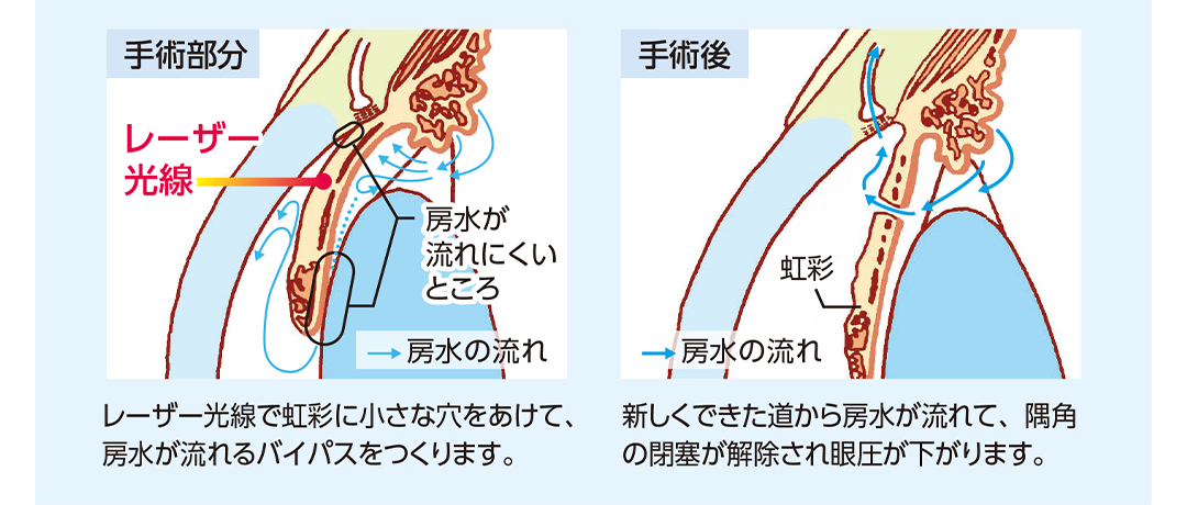 レーザー虹彩切開術の手術部分、手術後の状態を示したイラスト