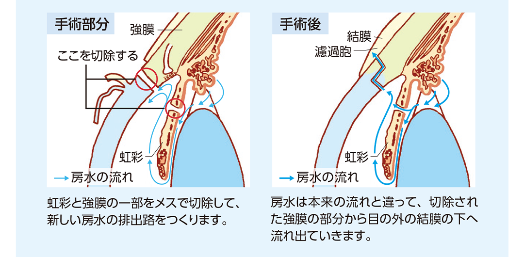濾過手術の手術部分、手術後の状態を示したイラスト