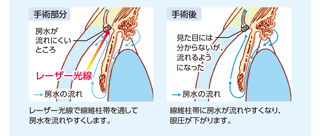 レーザー線維中帯形成術の手術部分、手術後の状態を示したイラスト