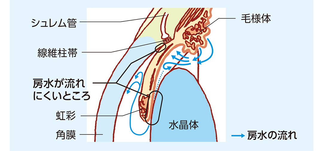 原発閉塞隅角緑内障の房水の流れを示したイラスト
