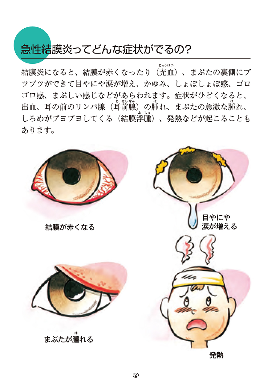 急性結膜炎ってどんな症状がでるの？
