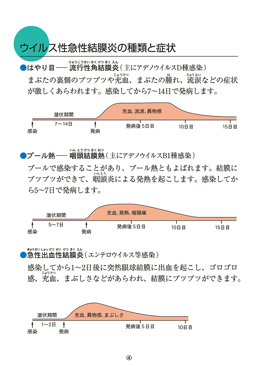 ウイルス性急性結膜炎の種類と症状