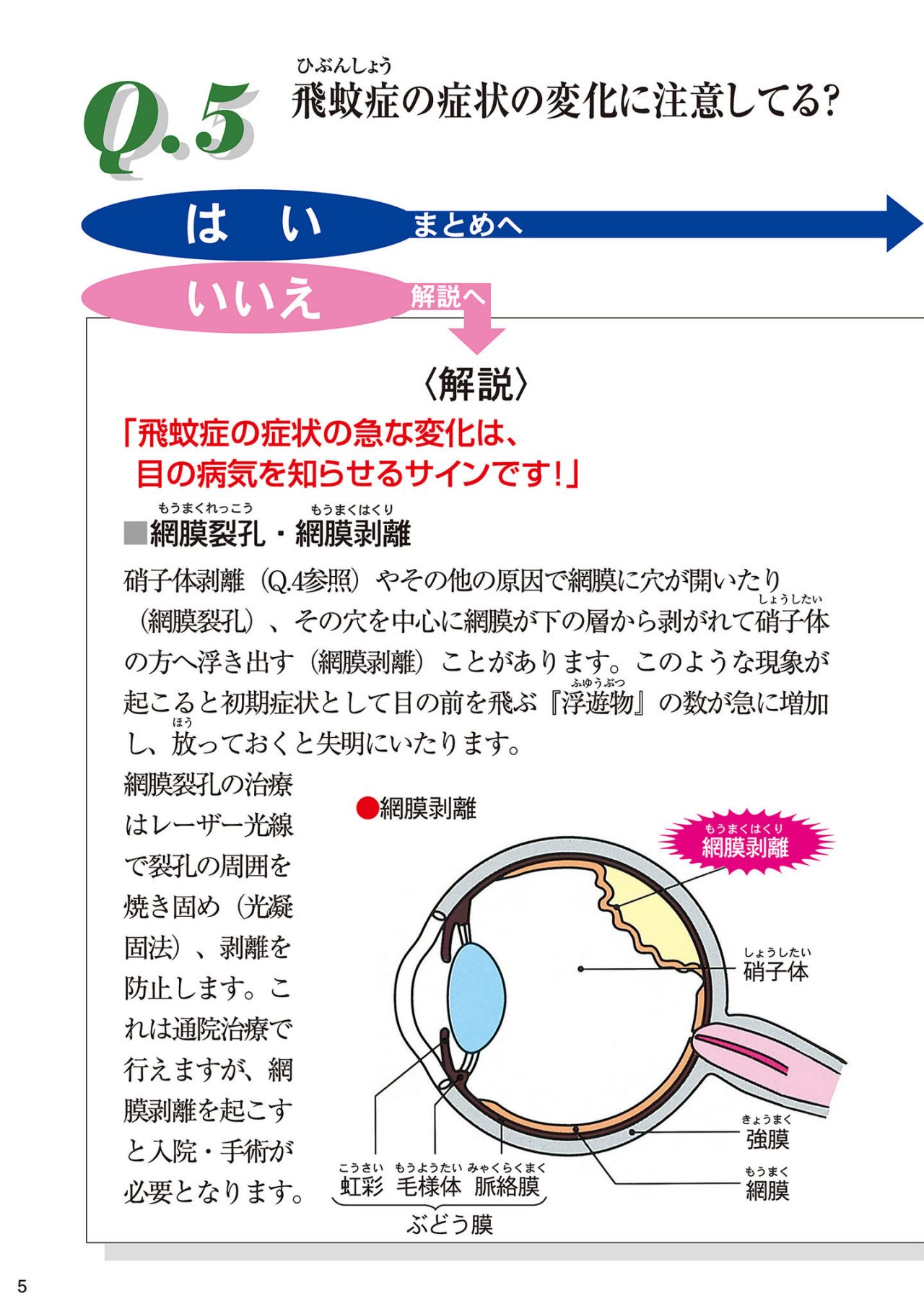 飛蚊症の症状の変化に注意してる？