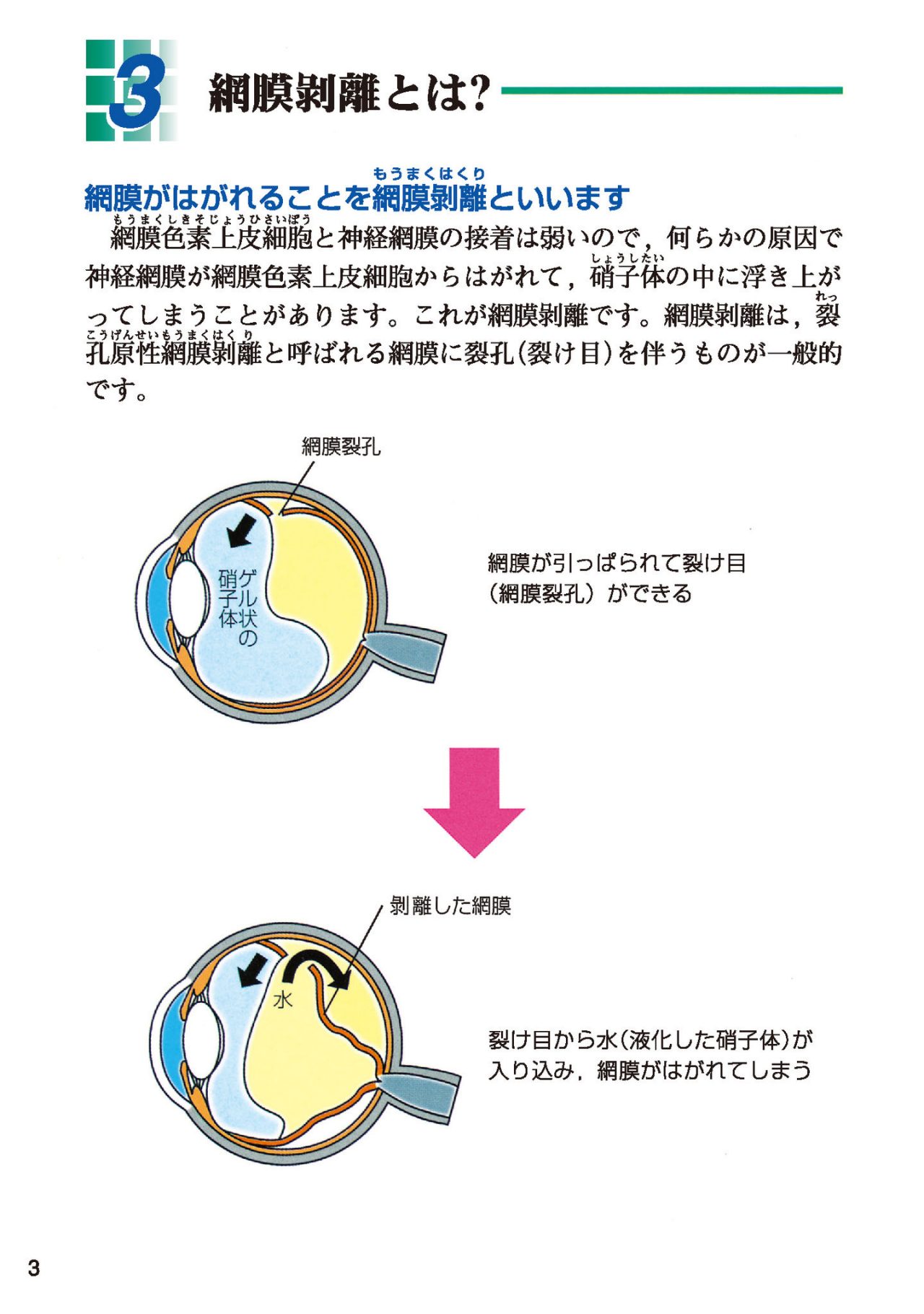 網膜剥離とは？