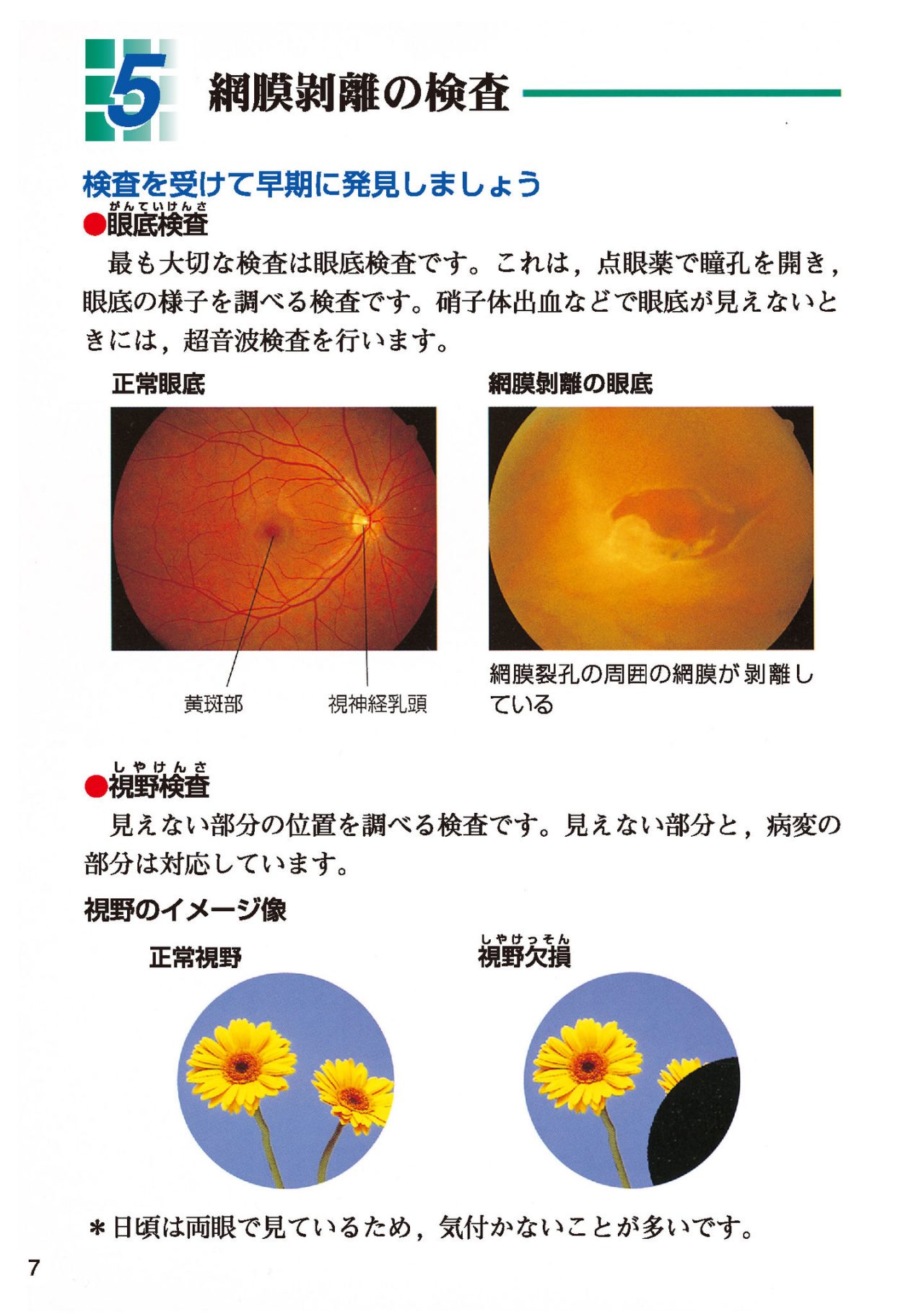 網膜剥離の検査