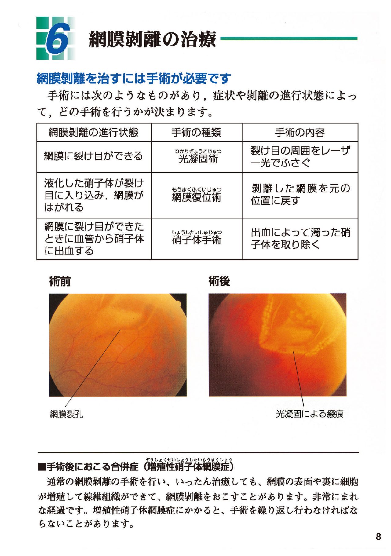 網膜剥離の治療