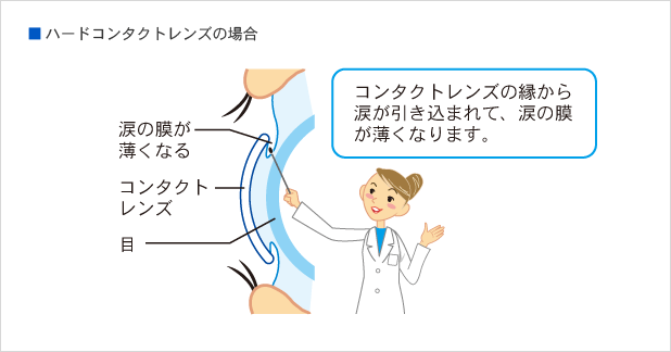 ハードコンタクトレンズを装着したときに涙の膜が薄くなるようすを説明した図